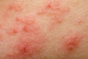 Dermatitis At Pica Eczema At Pico Eczema Symptoms Treatment